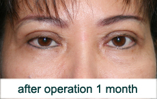 plastic-surgery-blepharoplasty